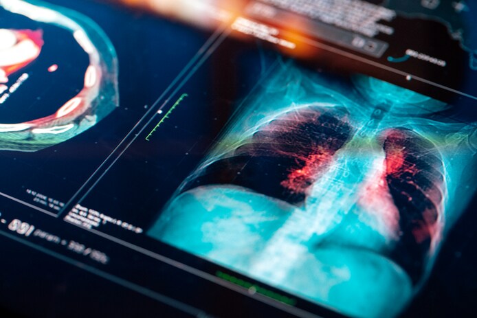 Patiënten merken vaak niet dat ze longkanker hebben: oncoloog legt uit |  Binnenland | bd.nl